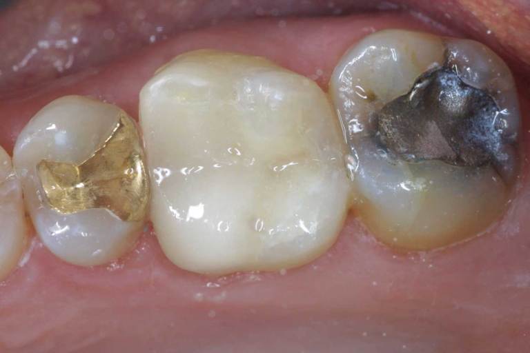 Silver and Gold Fillings - Amalgam Fillings